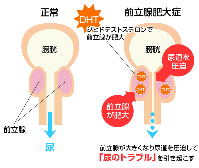 前立腺肥大症