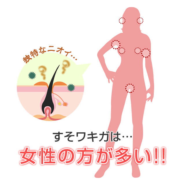 ワキガの原因であるアポクリン汗線がデリケートゾーンにあるとすそワキガになる