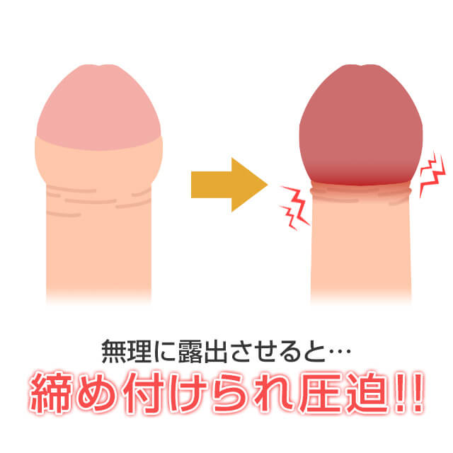カントン包茎は亀頭部分が極端に少ないので早漏になりやすく、無理に亀頭を露出させると根元が圧迫されてしまう