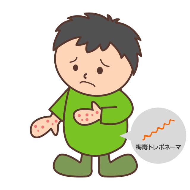 梅毒トレポネーマという細菌が人間の体内へ侵入して発症する感染症が梅毒