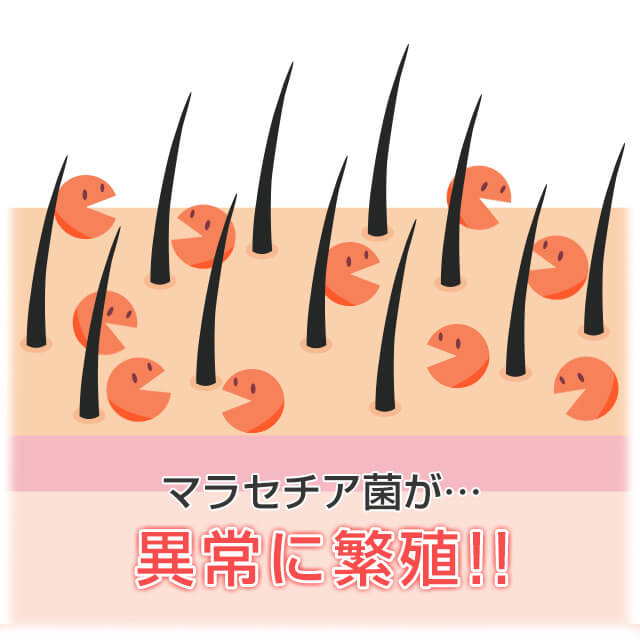 粃糠性脱毛症はマラセチア菌が異常繁殖することが原因のひとつ
