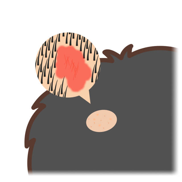ストレスが原因で自分の髪の毛を抜くことが癖になっているのを抜毛症という