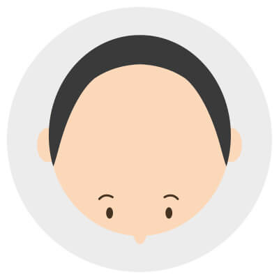 U字ハゲは中央部分の後退が激しく薄毛の深刻度も高い